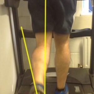 Video Gait Analysis